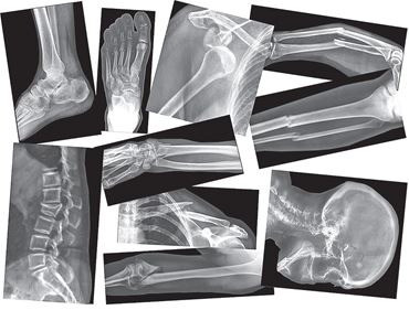 Broken Bone X-Ray Set for Anatomy Studies