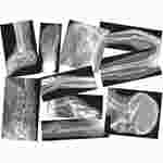 Broken Bone X-Ray Set for Anatomy Studies